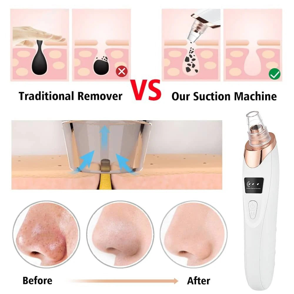 Professional Digital Blackhead Remover Vacuum – Electric Pore Cleaner & Acne Removal Facial Tool with LED Display